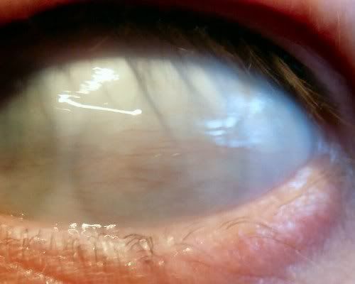 Eye With 2 Pupils,pupula duplex,double pupil